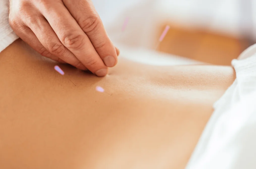 dry-needling-1