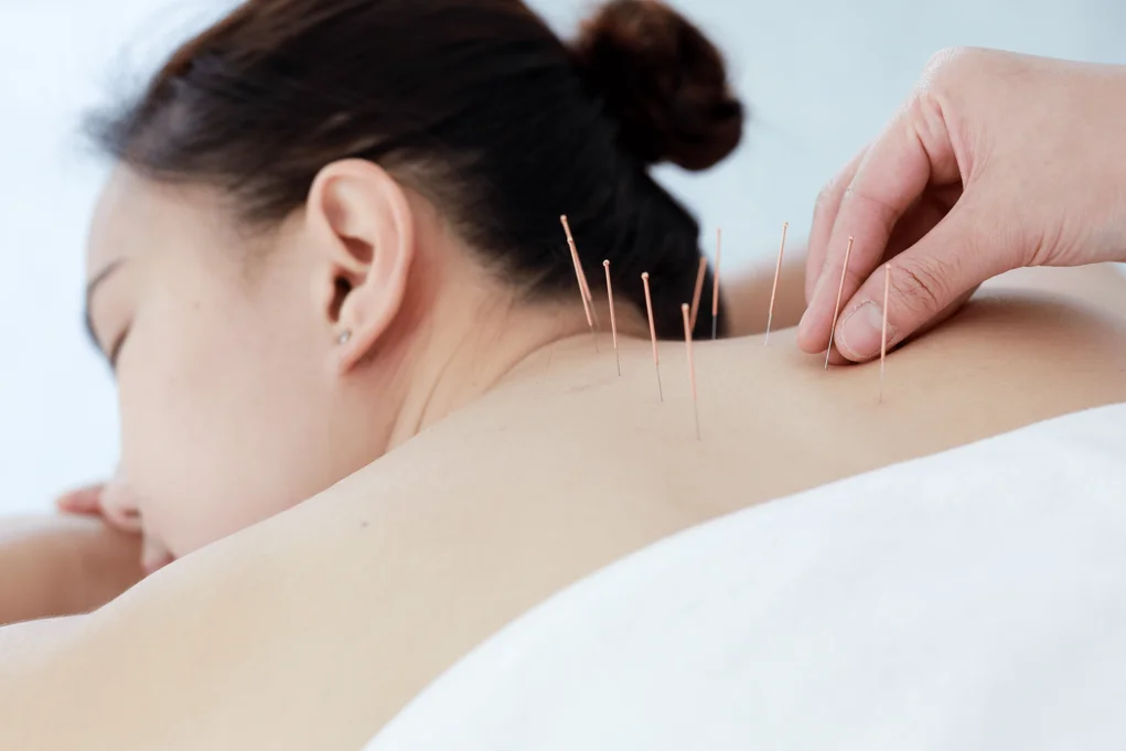 dry-needling-2