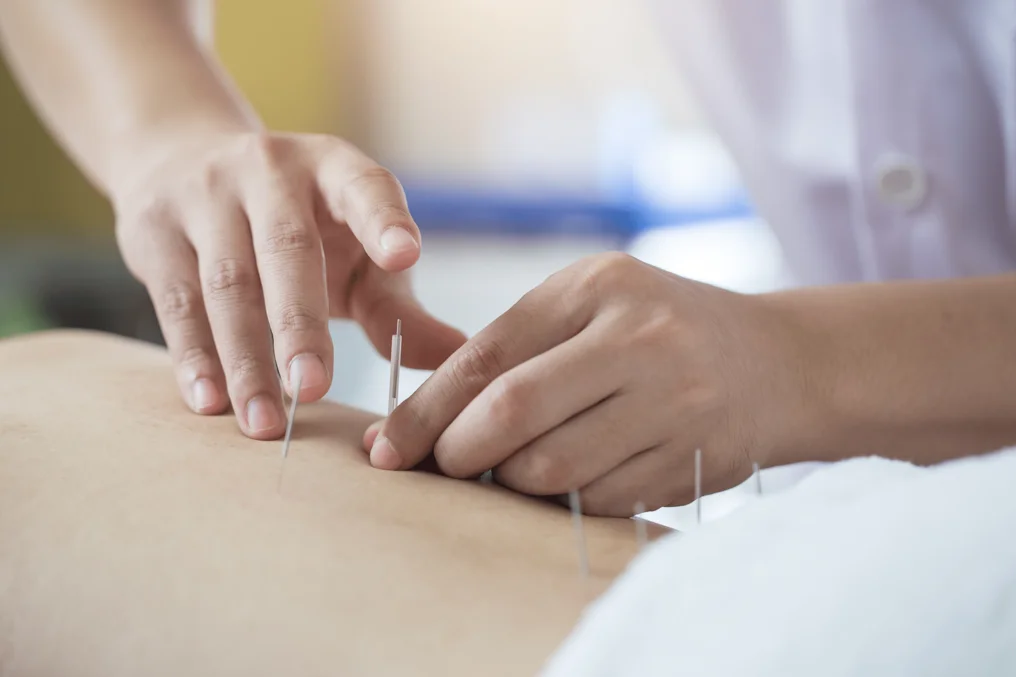 dry-needling-3